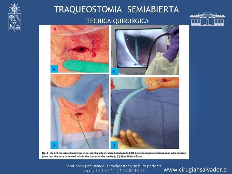 Diapositiva 31 de Traqueostomía