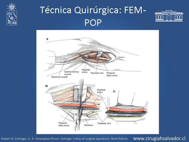 Diapositiva 28 de Manejo quirúrgico de la enfermedad arterial infrainguinal: Accesos 