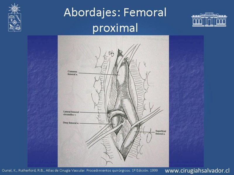 Diapositiva 15 de Manejo quirúrgico de la enfermedad arterial infrainguinal: Accesos 