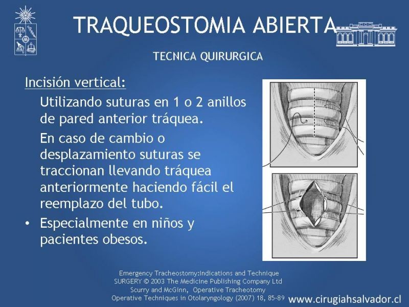 Diapositiva 18 de Traqueostomía