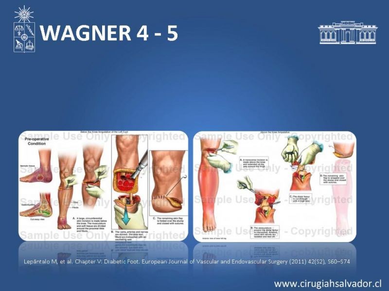Diapositiva 21 de Pie diabético: Manejo