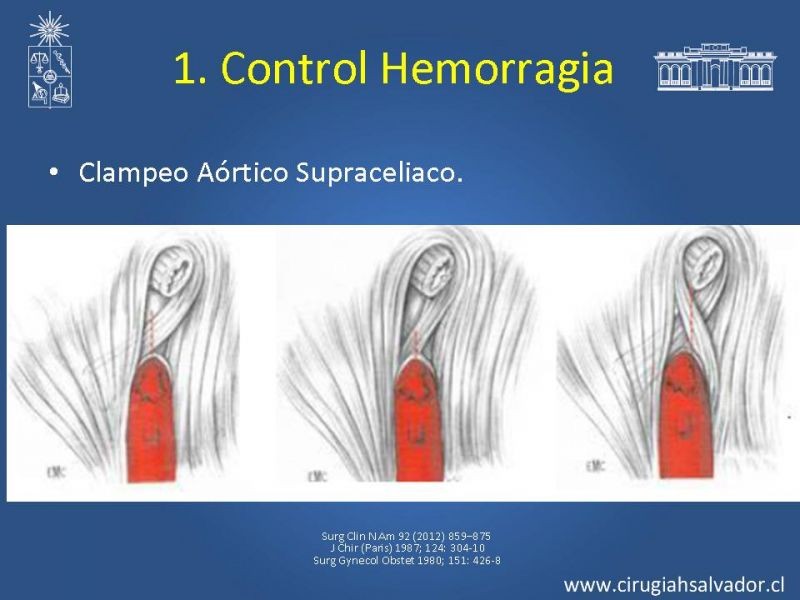 Diapositiva 9 de Damage Control Surgery (técnica quirúrgica) pt. 1