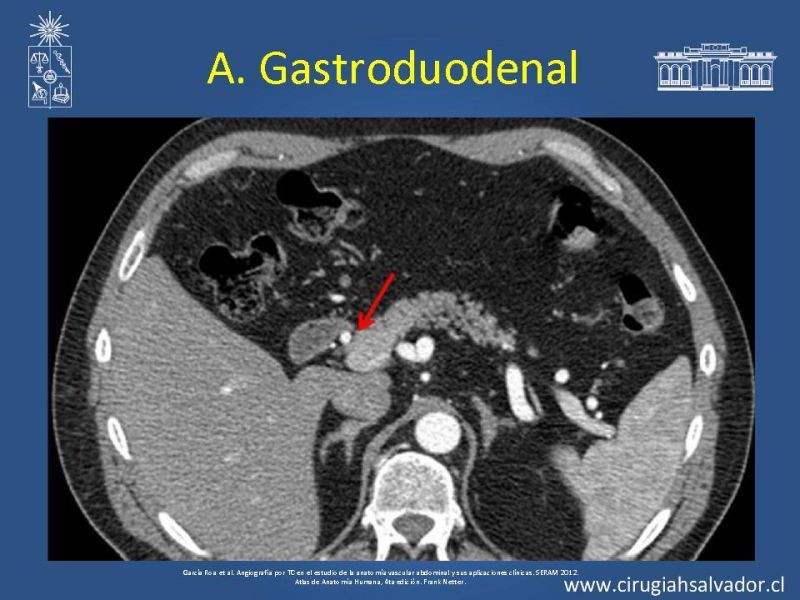 Diapositiva 13 de Anatomía e Imagenología Vascular Arterial Intra-abdominal