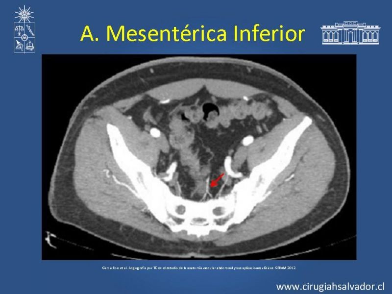 Diapositiva 38 de Anatomía e Imagenología Vascular Arterial Intra-abdominal