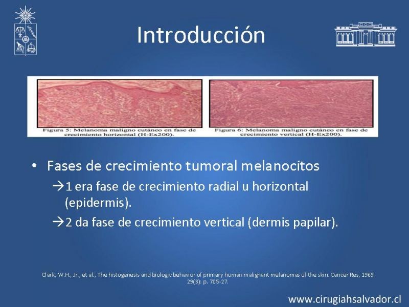 Diapositiva 4 de Melanoma