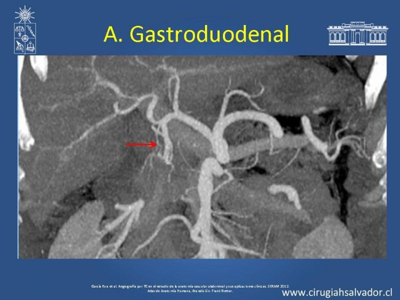 Diapositiva 14 de Anatomía e Imagenología Vascular Arterial Intra-abdominal