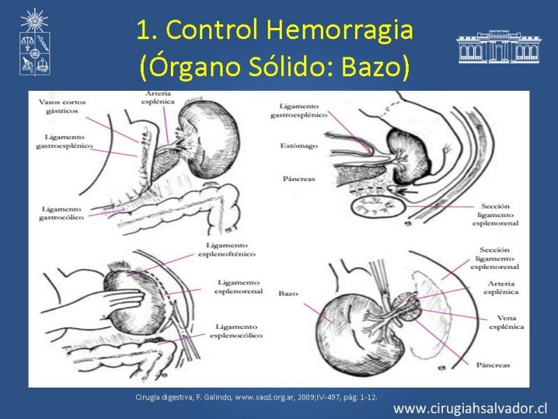 Diapositiva 42 de Damage Control Surgery (técnica quirúrgica) pt. 1