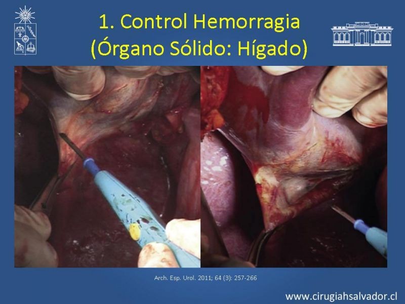 Diapositiva 31 de Damage Control Surgery (técnica quirúrgica) pt. 1