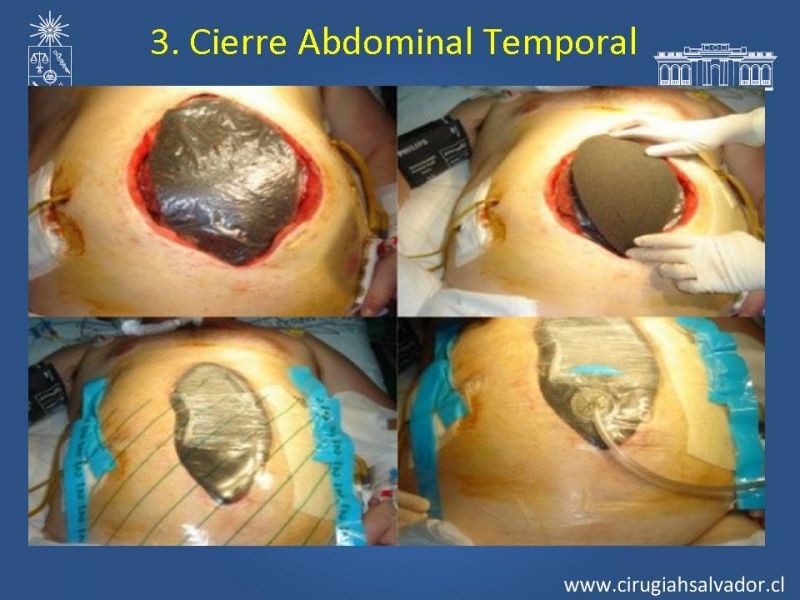 Diapositiva 13 de Damage Control Surgery (técnica quirúrgica) pt. 3