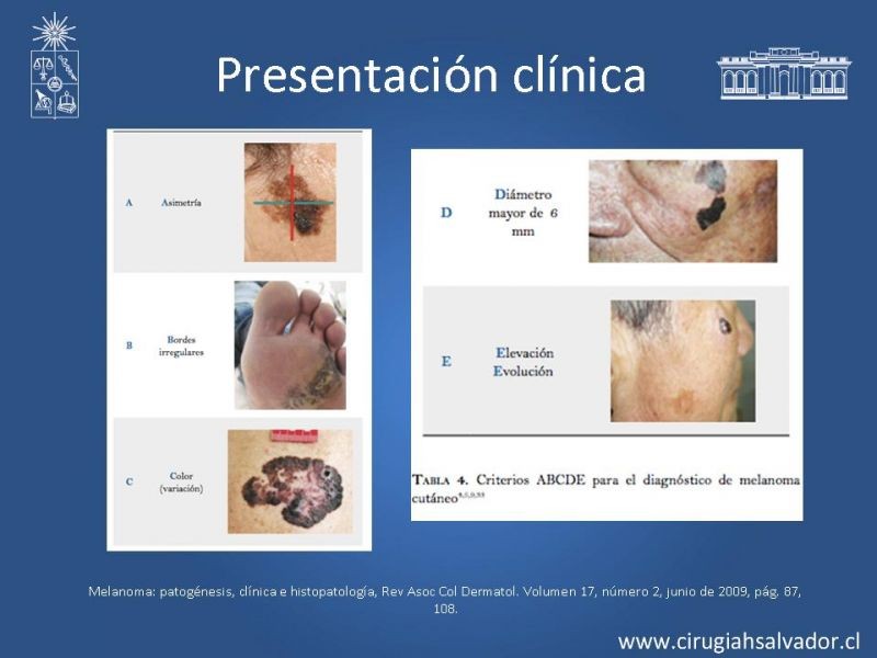 Diapositiva 7 de Melanoma