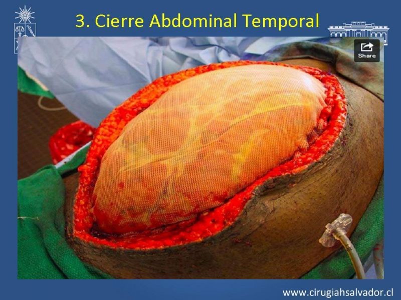 Diapositiva 9 de Damage Control Surgery (técnica quirúrgica) pt. 3