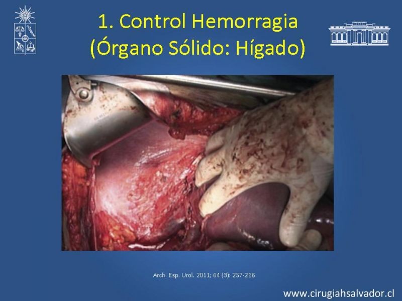 Diapositiva 32 de Damage Control Surgery (técnica quirúrgica) pt. 1