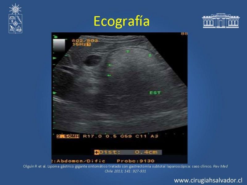 Diapositiva 7 de Lipoma Gástrico