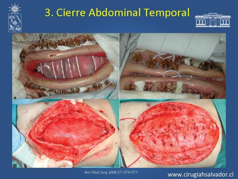 Diapositiva 19 de Damage Control Surgery (técnica quirúrgica) pt. 3