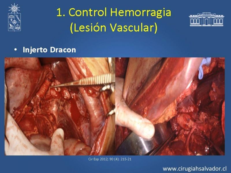 Diapositiva 19 de Damage Control Surgery (técnica quirúrgica) pt. 2