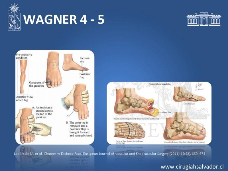 Diapositiva 20 de Pie diabético: Manejo