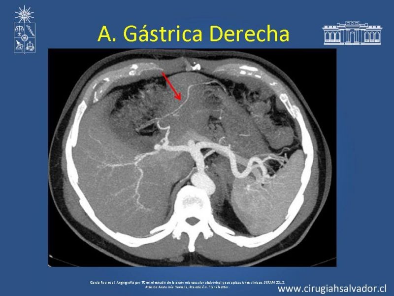 Diapositiva 18 de Anatomía e Imagenología Vascular Arterial Intra-abdominal