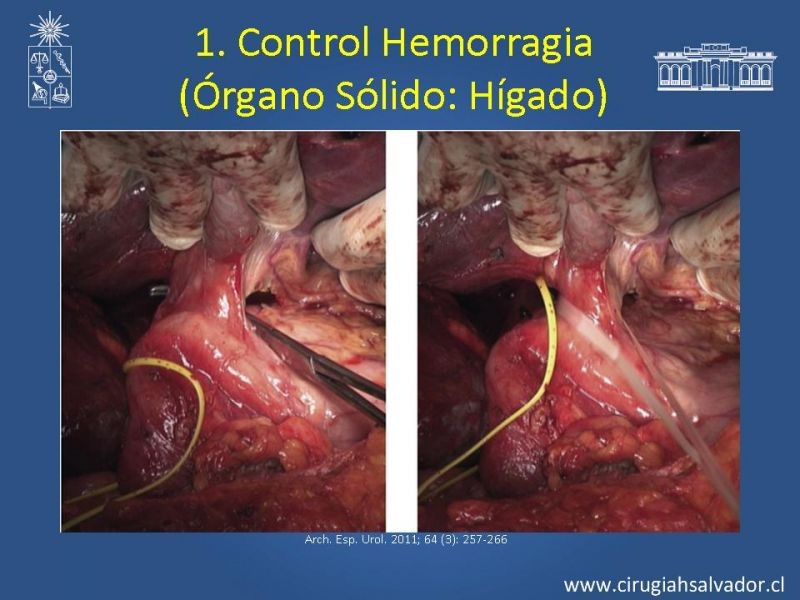 Diapositiva 25 de Damage Control Surgery (técnica quirúrgica) pt. 1
