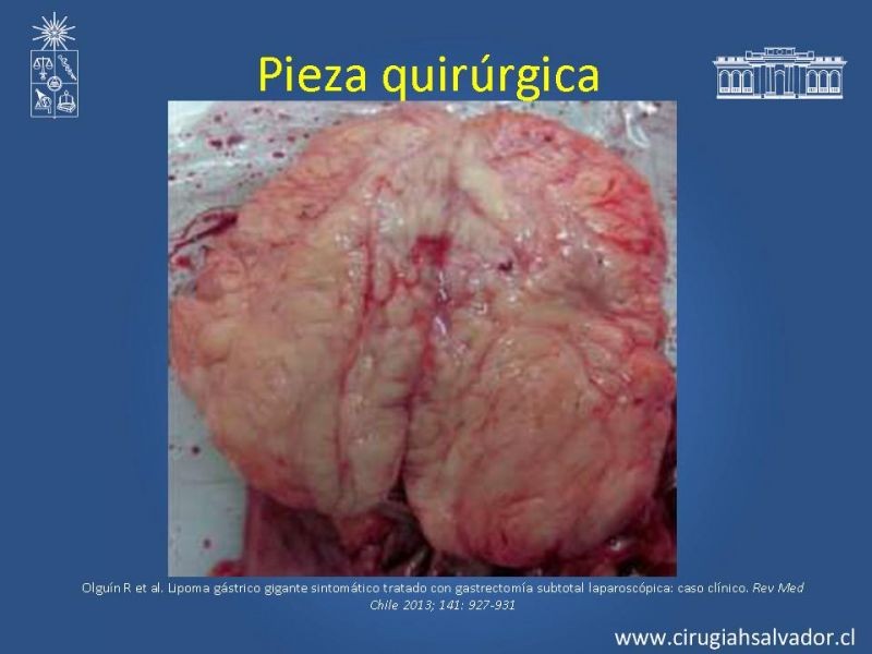 Diapositiva 13 de Lipoma Gástrico
