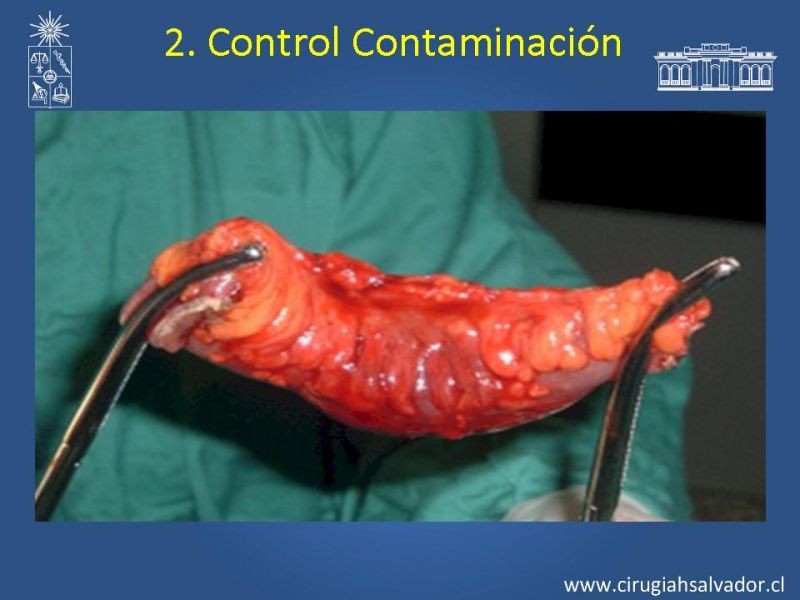 Diapositiva 27 de Damage Control Surgery (técnica quirúrgica) pt. 2