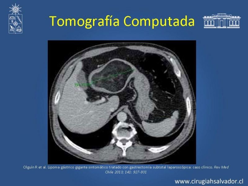 Diapositiva 11 de Lipoma Gástrico