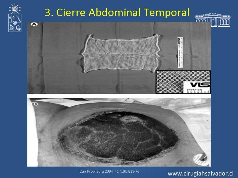 Diapositiva 8 de Damage Control Surgery (técnica quirúrgica) pt. 3