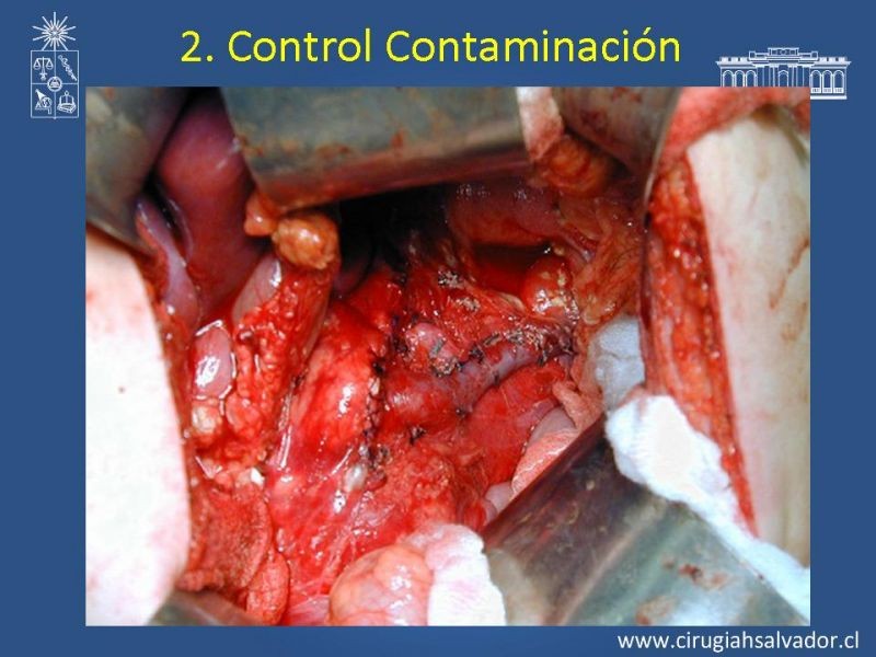 Diapositiva 38 de Damage Control Surgery (técnica quirúrgica) pt. 2
