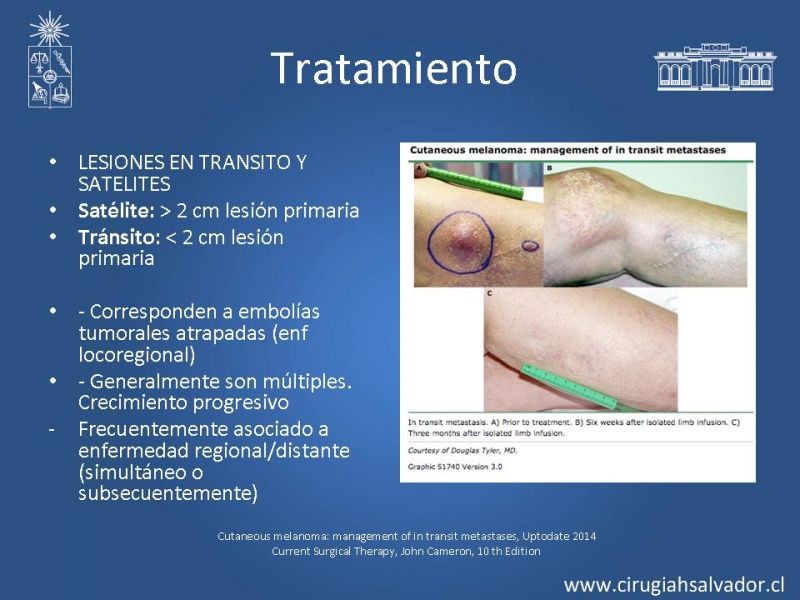 Diapositiva 23 de Melanoma