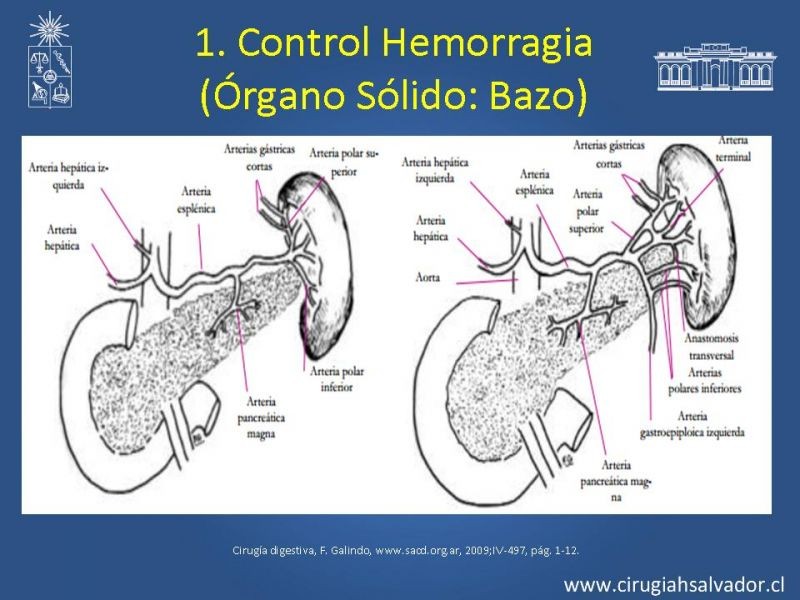 Diapositiva 41 de Damage Control Surgery (técnica quirúrgica) pt. 1