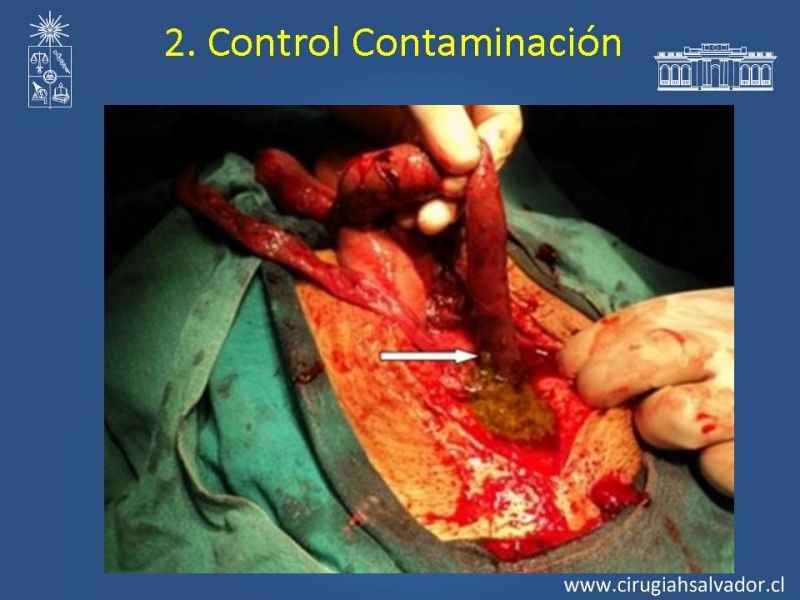 Diapositiva 28 de Damage Control Surgery (técnica quirúrgica) pt. 2