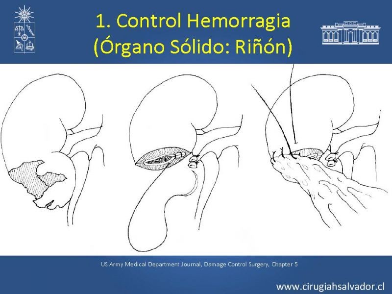 Diapositiva 3 de Damage Control Surgery (técnica quirúrgica) pt. 2