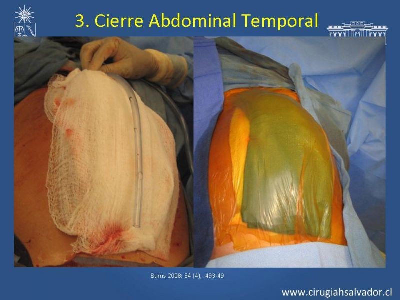 Diapositiva 2 de Damage Control Surgery (técnica quirúrgica) pt. 3