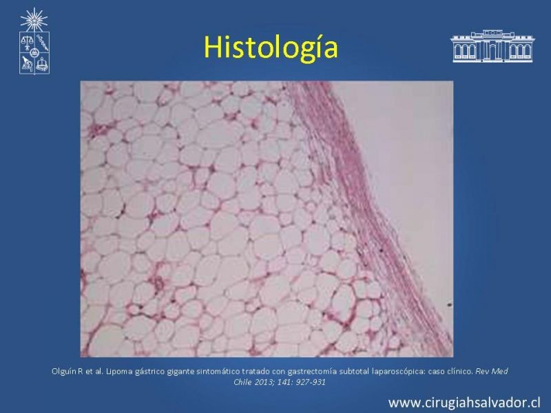 Diapositiva 4 de Lipoma Gástrico