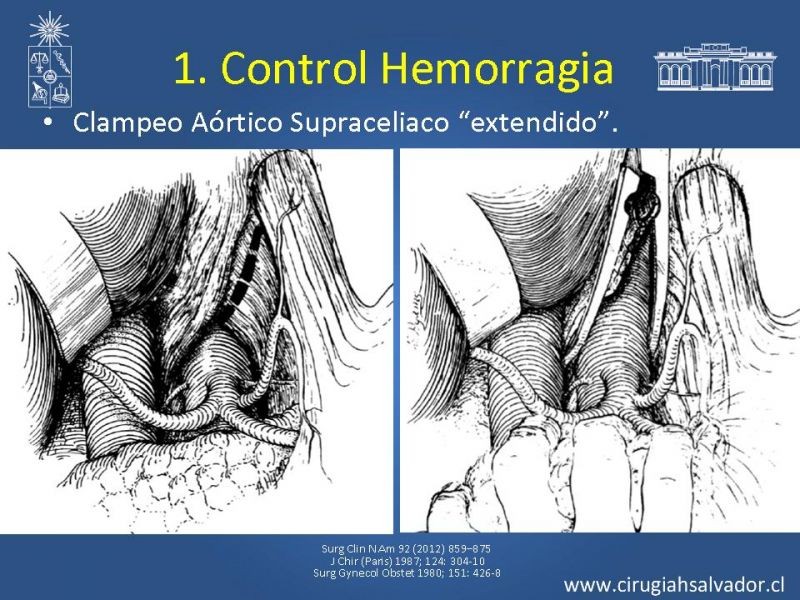 Diapositiva 11 de Damage Control Surgery (técnica quirúrgica) pt. 1
