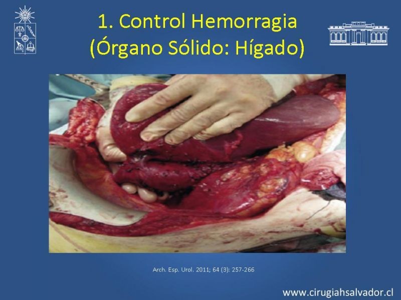 Diapositiva 35 de Damage Control Surgery (técnica quirúrgica) pt. 1