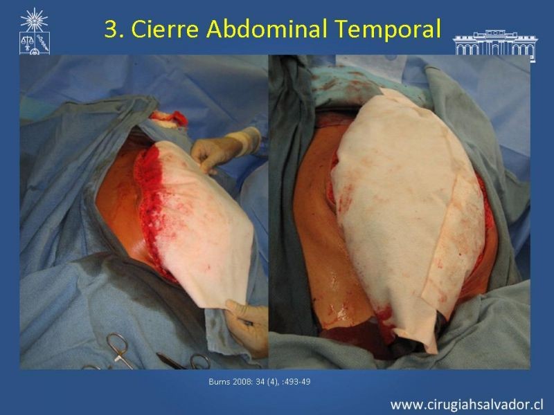 Diapositiva 1 de Damage Control Surgery (técnica quirúrgica) pt. 3