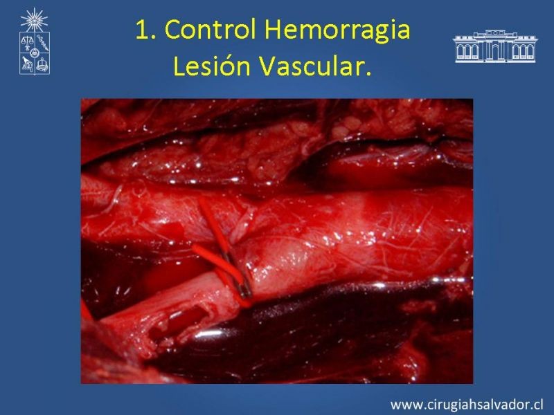 Diapositiva 4 de Damage Control Surgery (técnica quirúrgica) pt. 2