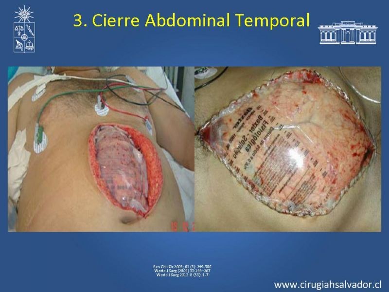 Diapositiva 43 de Damage Control Surgery (técnica quirúrgica) pt. 2