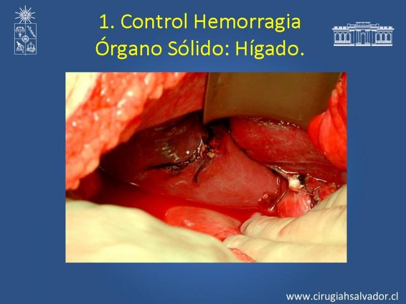 Diapositiva 20 de Damage Control Surgery (técnica quirúrgica) pt. 1