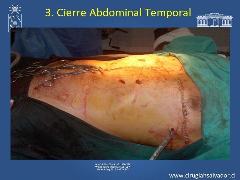 Diapositiva 42 de Damage Control Surgery (técnica quirúrgica) pt. 2