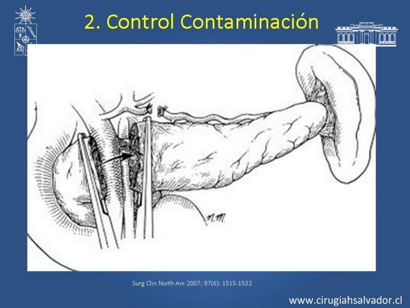 Diapositiva 36 de Damage Control Surgery (técnica quirúrgica) pt. 2