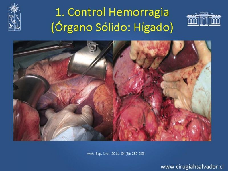 Diapositiva 34 de Damage Control Surgery (técnica quirúrgica) pt. 1