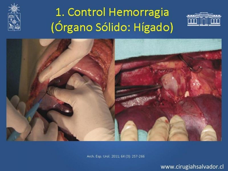 Diapositiva 30 de Damage Control Surgery (técnica quirúrgica) pt. 1