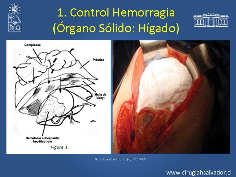 Diapositiva 27 de Damage Control Surgery (técnica quirúrgica) pt. 1