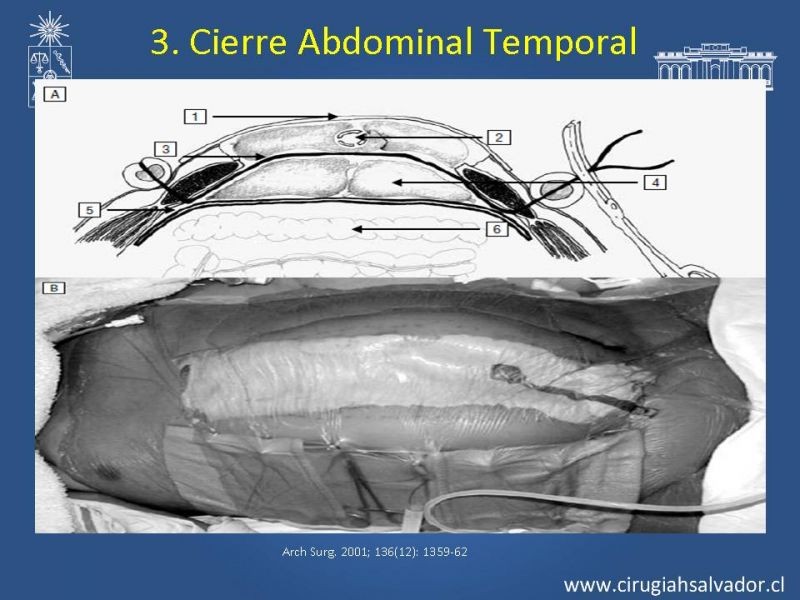 Diapositiva 4 de Damage Control Surgery (técnica quirúrgica) pt. 3
