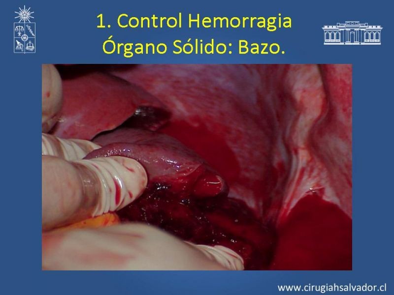 Diapositiva 38 de Damage Control Surgery (técnica quirúrgica) pt. 1