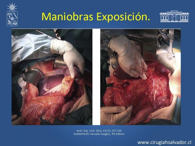 Diapositiva 18 de Damage Control Surgery (técnica quirúrgica) pt. 1