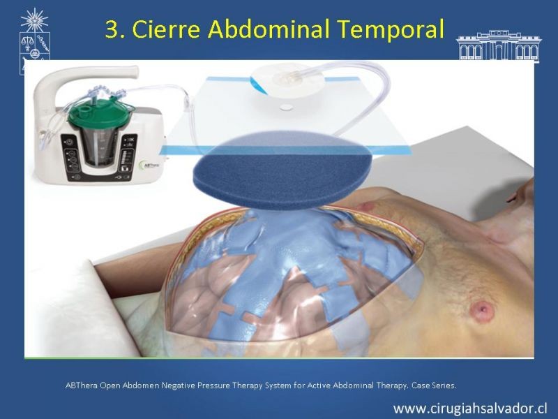 Diapositiva 16 de Damage Control Surgery (técnica quirúrgica) pt. 3
