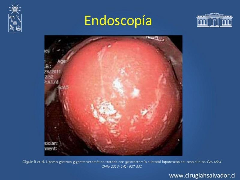 Diapositiva 9 de Lipoma Gástrico
