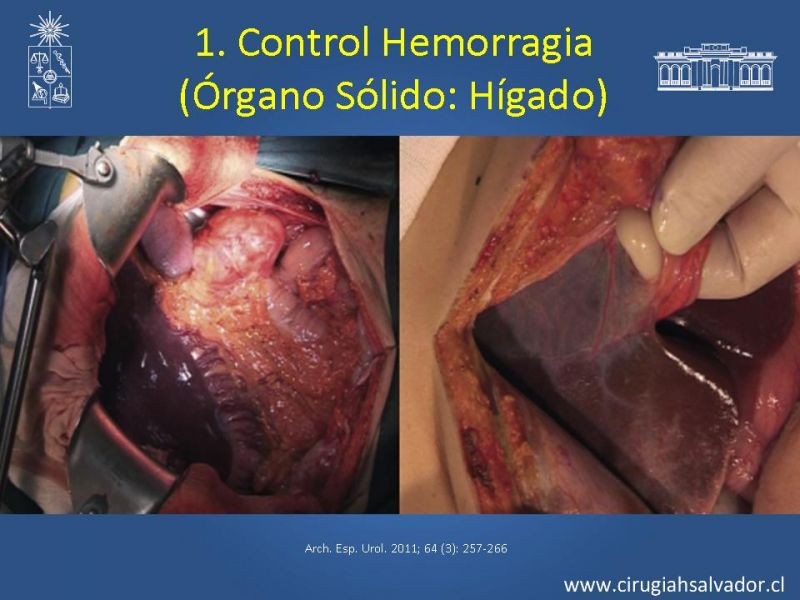 Diapositiva 29 de Damage Control Surgery (técnica quirúrgica) pt. 1